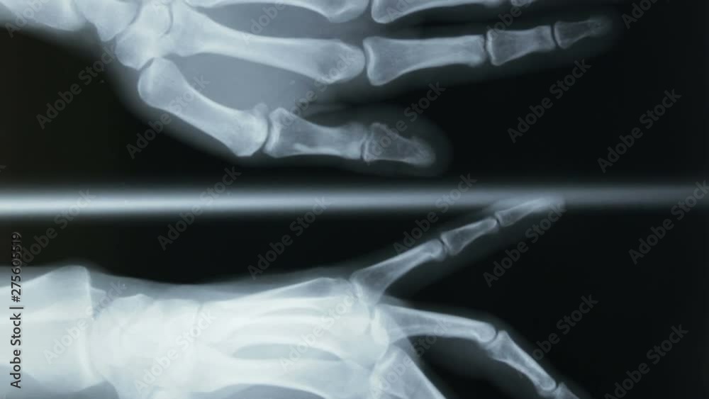 Vertical shot of a radiograph of the bones of the human hand, in ...
