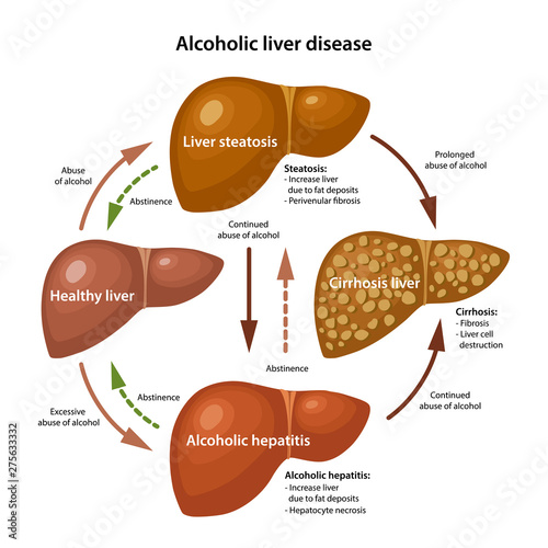 Stages of alcoholic liver disease with description corresponding steps. Anatomical vector illustration in flat style isolated over white background