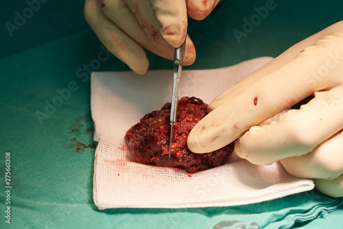 Fototapeta Naklejka Na Ścianę i Meble -  Surgeon cutting specimen in the brain causing seizure.