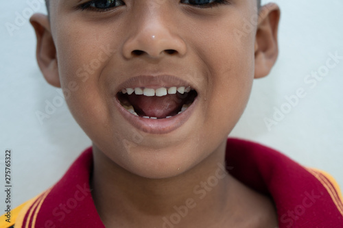 Little boy smiling with Broken teeth
