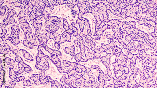 Microscopic image showing histology of a parathyroid adenoma, a benign tumor which releases parathyroid hormone into the blood system resulting in abnormally high calcium levels (hypercalcemia).   photo