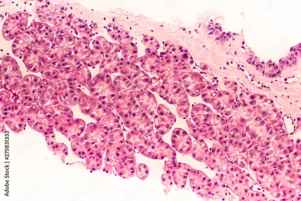 Liver cancer awareness, core biopsy: Photomicrograph of hepatocellular carcinoma (hepatoma), a malignant tumor often associated with chronic hepatitis B. 