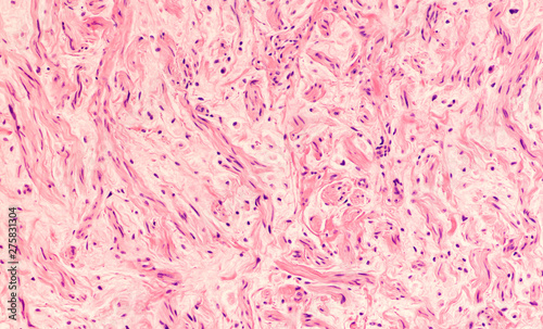 Micrograph of a neuroma, a painful benign proliferation of nerve fibers,  usually post-traumatic.   photo