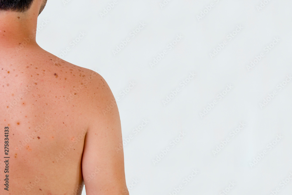 A male shoulder with sunspots