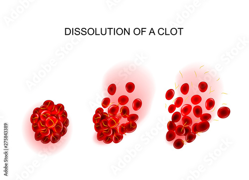 dissolution of the clot. thrombolysis photo