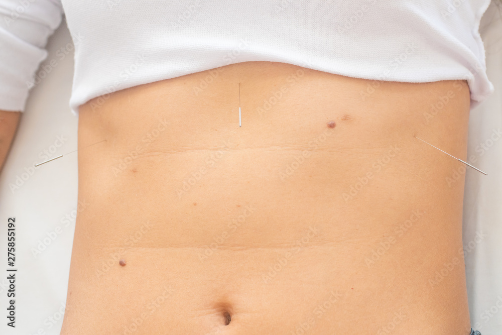 Acupuncture needles in the belly Acupuncture needles in the belly