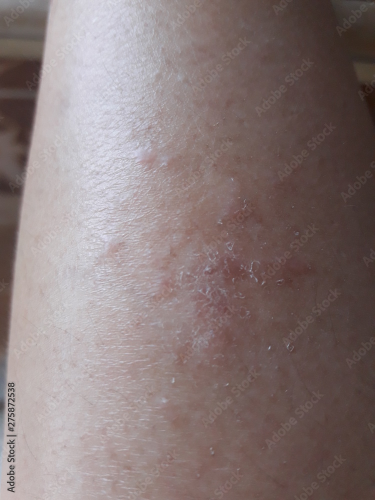 Fototapeta premium Skin diseases