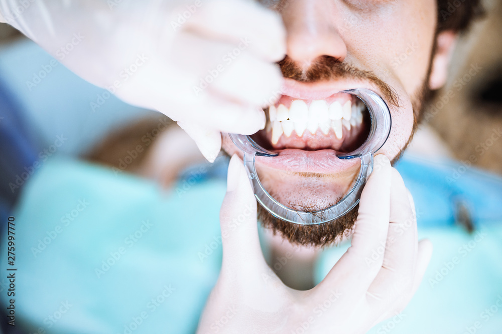 Foto Stock Denti di un ragazzo dal dentista visto con l'apribocca