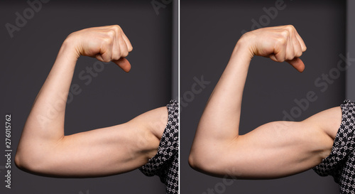 Obraz na płótnie A before and after view on the arm of a young Caucasian woman