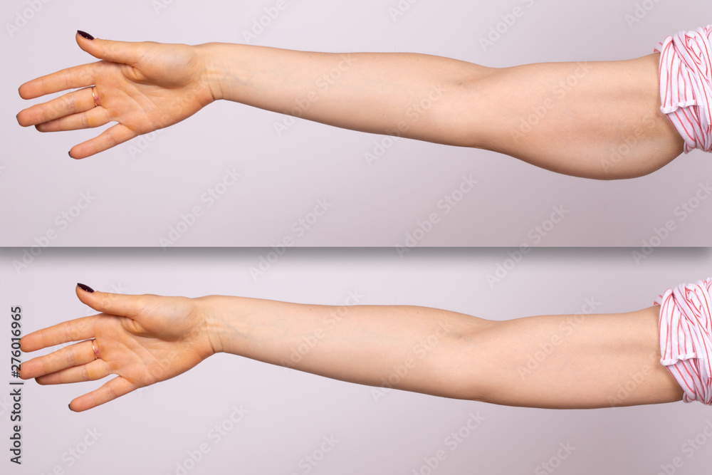 A before and after comparison of a young Caucasian woman who had a  brachioplasty. Corrective arm lift surgery which removes the sagging fat  layer from the triceps area. Photos