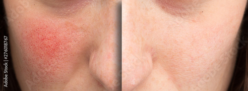 A before and after view of rosacea treatment. Young Caucasian woman shows results of laser surgery to the cheek and face to remove superficial dilated blood vessels.