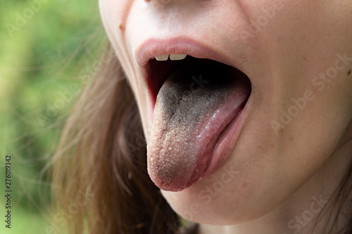 A girl with a black furry tongue is viewed closeup. Symptoms of enterobacter cloacae bacteria infection. Copy space on the left. photo
