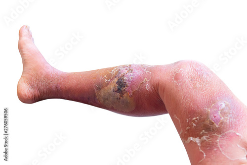 Erysipelas bacterial infection Under the skin leg aged people On  white background photo