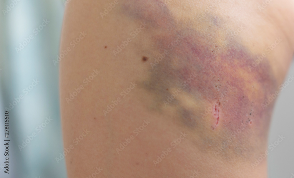 bruise on hip of a child bruise on hip of a child