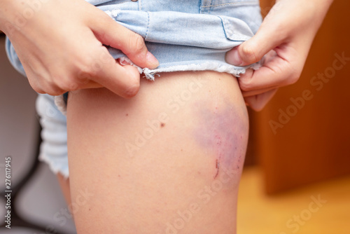 bruise on hip of a child