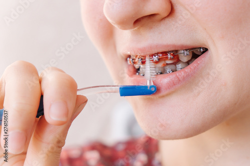 The girl cleans the remains of food from the braces with a special brush for interdental spaces