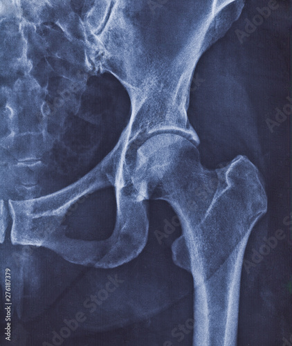 X-ray image of hip joint with signs of coxarthrosis