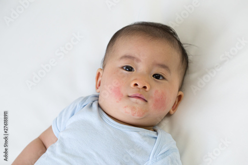Asian baby boy lying on the bed and had a red rash on the face, Skin common rashes in newborn concept