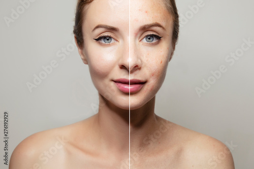 woman face portrait halved with clear and pimpled skin