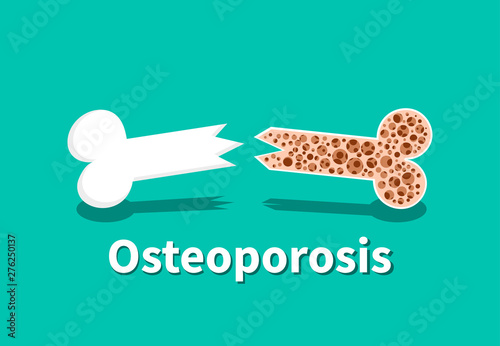 Osteoporosis, Bone structure in vector art design