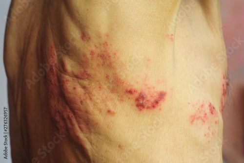Shingles is a viral infection that causes a painful rash photo