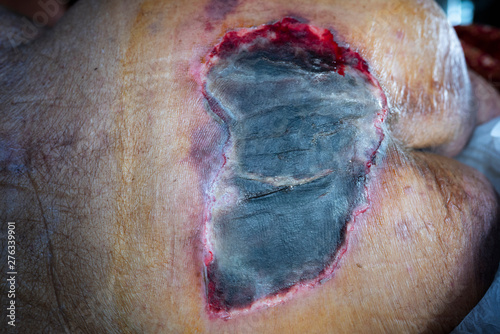 Close up infected bed sore wound photo