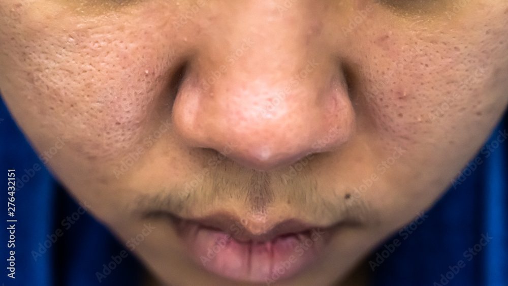 Obraz premium Facial acne is Asian women aged 25-30 and pores wrinkles are allergic to cosmetics.