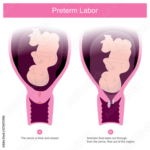 The premature birth, can occur in conditions of amniotic fluid leaks out through the cervix .and flow out of the vagina Including other factors that make the cervix open. photo
