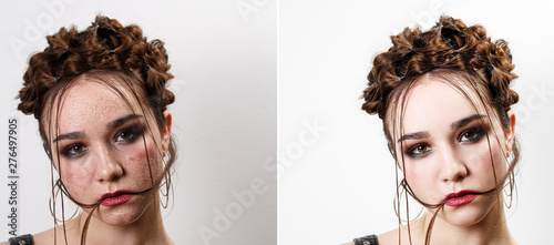 Young woman with acne skin. Before-after processing. Woman before and after retouch. Comparison portraits