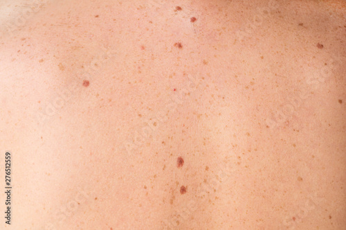 Close up detail of the bare skin on a man back with scattered moles and freckles. Checking benign moles. Sun effect on skin. Birthmarks on skin