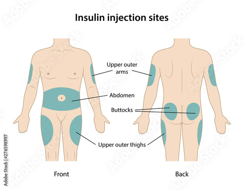 Diabetes. Insulin injection sites shown on the body: upper outer arms, abdomen, buttocks, upper outer thighs. Anatomical vector illustration in flat style isolated over white background.