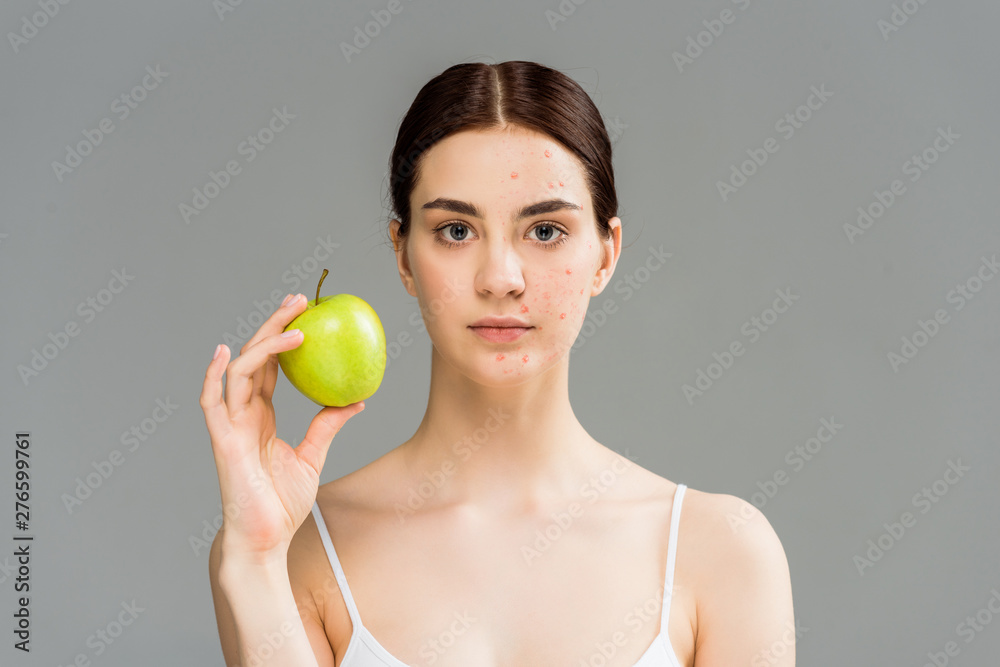 young woman with pimples on face holding green apple isolated on grey young woman with pimples on face holding green apple isolated on grey