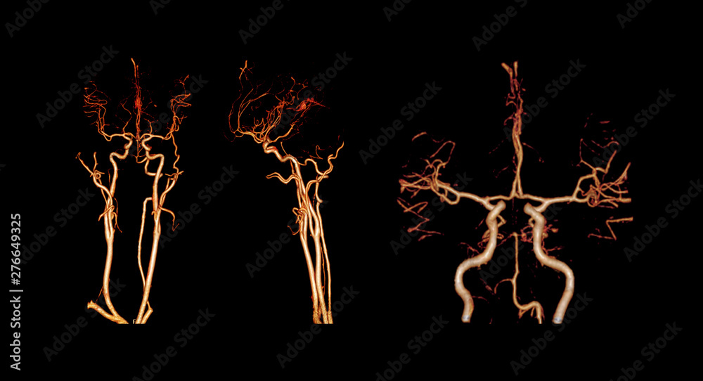 CTA BRAIN os CT angiography of the brain 3D Rendering image showing ...