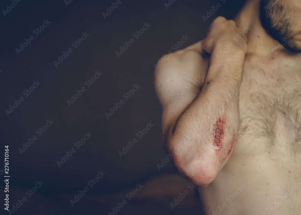 Fototapeta premium The young man was injured in sports.