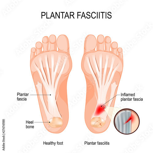 Plantar fasciitis. disorder of the connective tissue which supports the arch of the foot