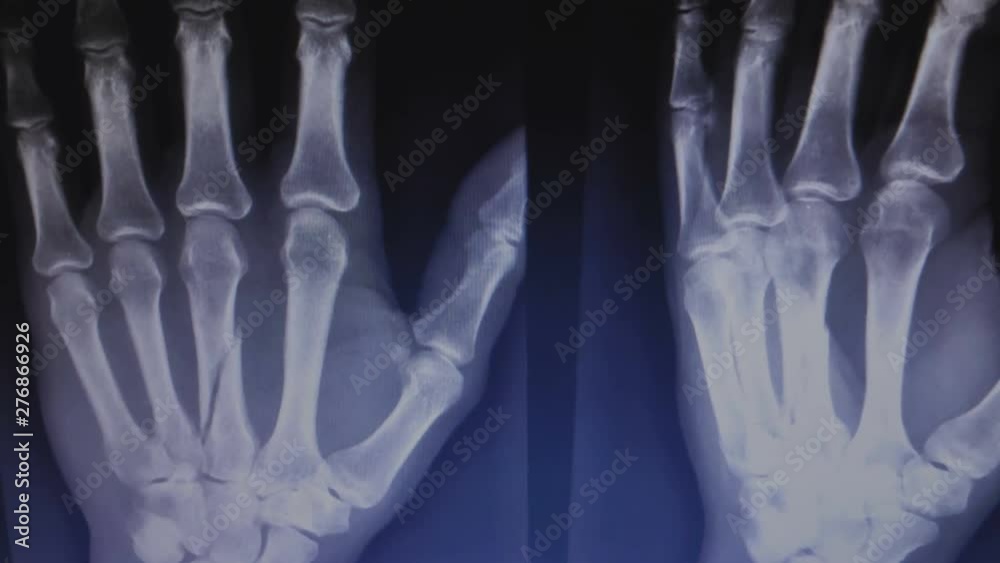 X-ray of a broken hand bone. Doctor shows fracture. Healthcare insurance concept. X-ray of a broken hand bone. Doctor shows fracture. Healthcare insurance concept.
