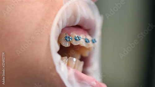 Patient Showing Teeth With Braces. Extreme Close Up