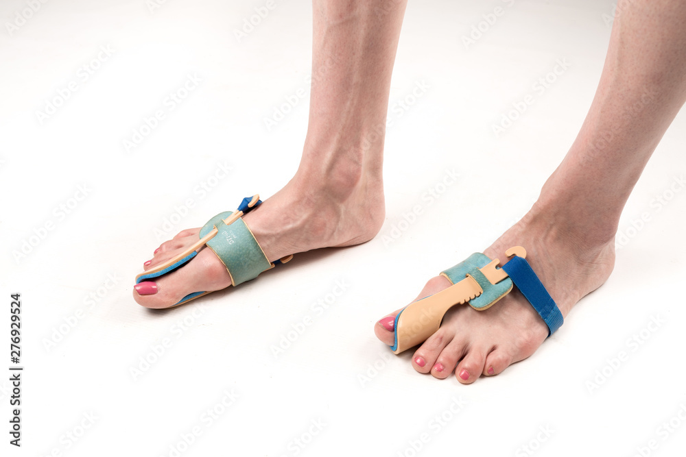 stabilizing orthosis for the correction of the big toe on the woman legs when hallux valgus, 2 legs, close-up isolated, white background stabilizing orthosis for the correction of the big toe on the woman legs when hallux valgus, 2 legs, close-up isolated, white background