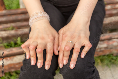 Young woman having rheumatoid arthritis takes a rest sittinng on a bench at a yard of a hospital. Hands and legs are deformed. She feels pain. Selected focus. photo