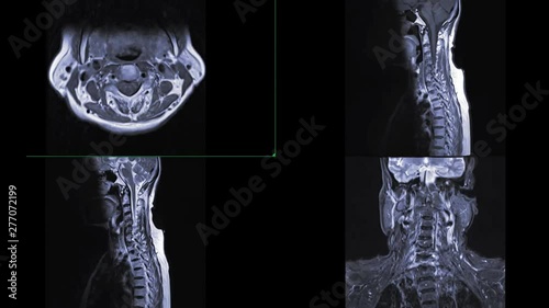 Comparison of MRI C-spine or magnetic resonance image of cervical spine Axial , Coronal and sagittal plane showing spondylosis  and compression fracture.