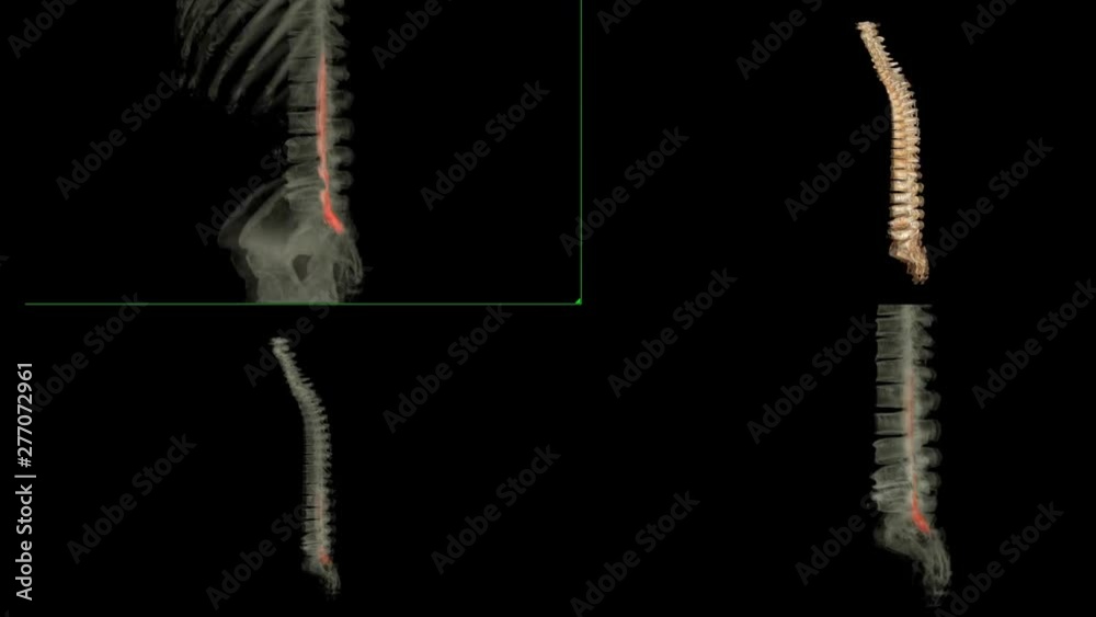 Comparison of CT myelography with whole spine 3D rendering image is ...