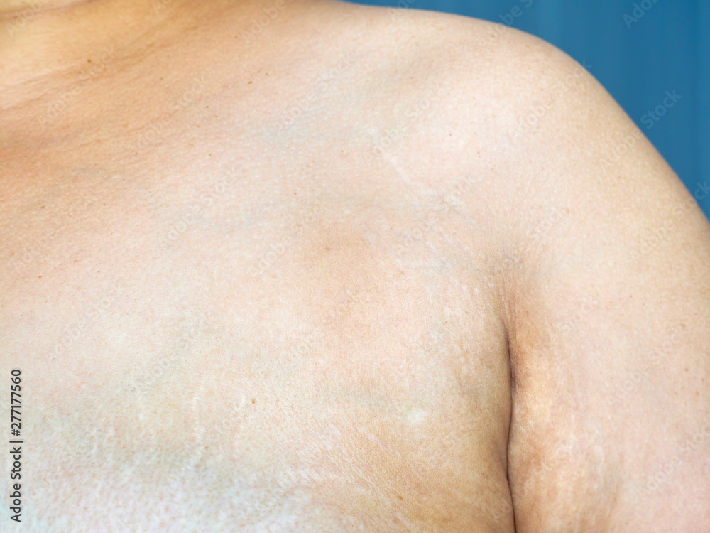 Stretch marks of the skin on the woman's chest Stretch marks of the skin on the woman's chest