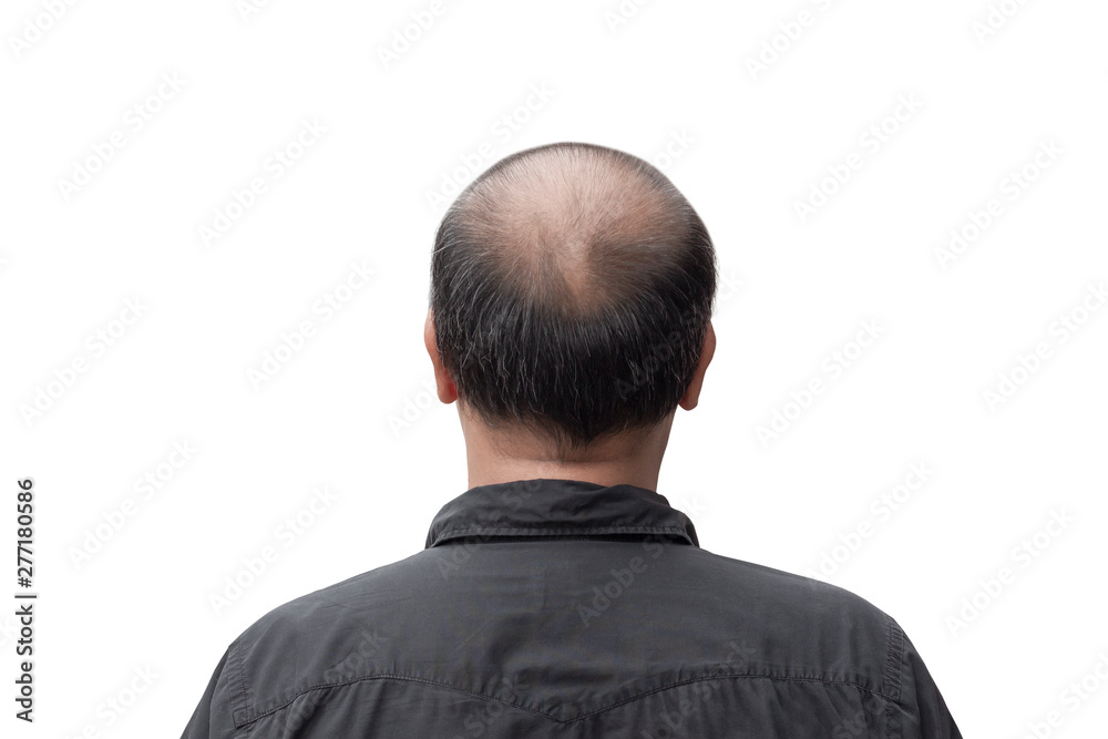 WHAT IS THIN HAIR MEN visual data 4