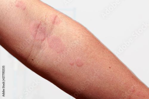 Around arm of men with dermatitis problem of rash ,allergy rash and Health problem.On white background