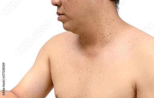 skin tags or Seborrheic Keratosis on neck