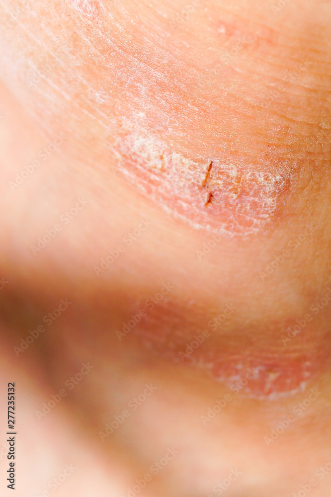 Fototapeta premium Psoriasis dry red and white irritation on the skin closeup.