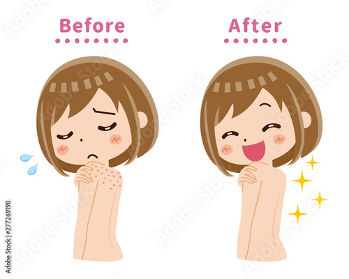 背中　ニキビ　湿疹　ビフォーアフター