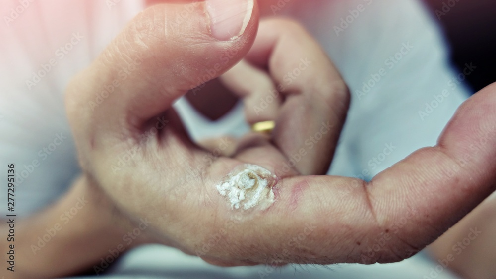 wart on finger after treatment by salicylic acid. wart on the finger verruca freeze, healthcare and medical concept, blurred neutral light background from the window, selective focus wart on finger after treatment by salicylic acid. wart on the finger verruca freeze, healthcare and medical concept, blurred neutral light background from the window, selective focus