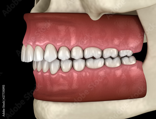 Overbite dental occlusion ( Malocclusion of teeth ). Medically accurate tooth 3D illustration