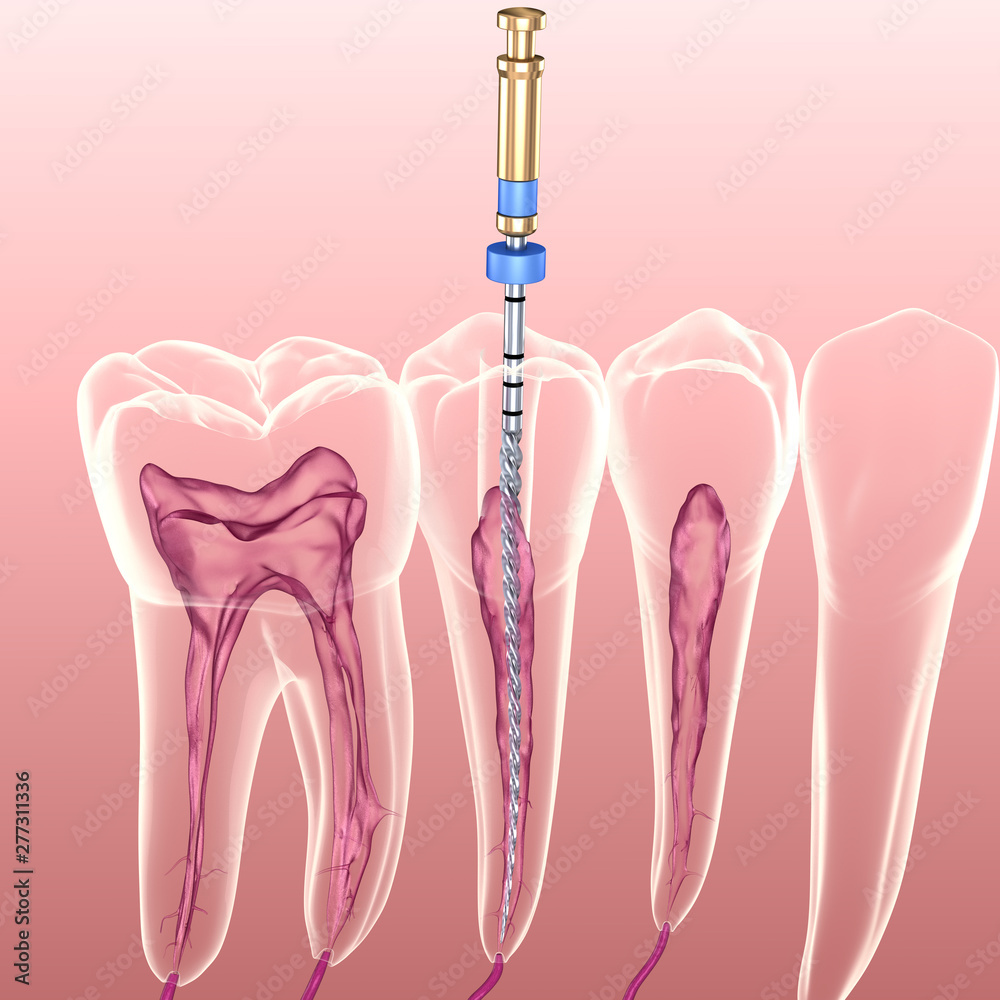 Endodontic root canal treatment process. Medically accurate tooth 3D illustration. - obrazy, fototapety, plakaty 